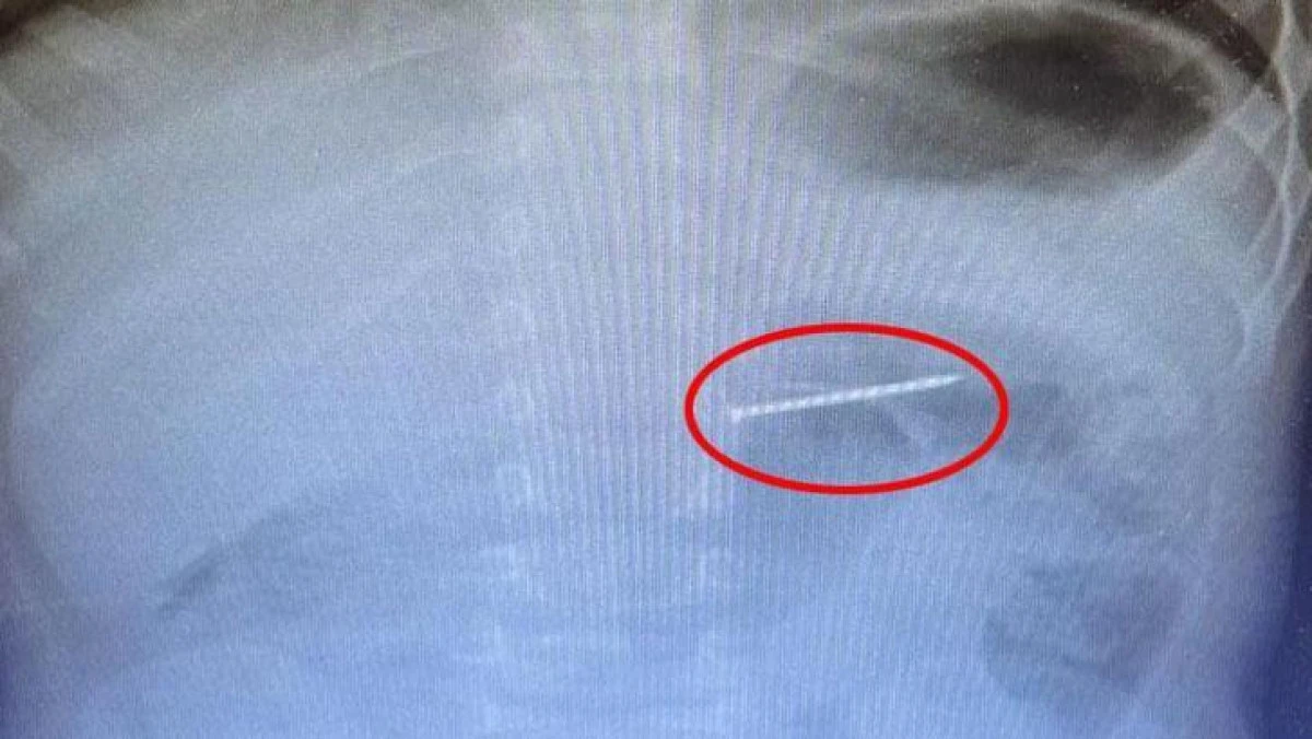 2 yaşındaki bebeğin yuttuğu çivi endoskopiyle çıkarıldı